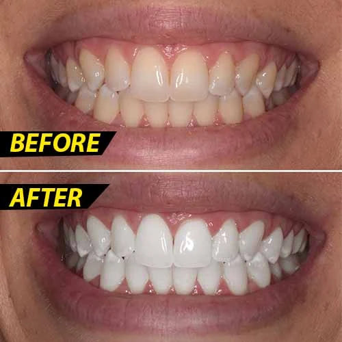 Oral Gel Teeth Tooth Whitening